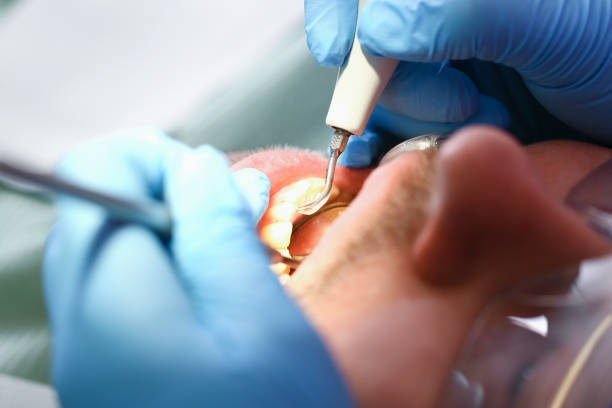 Best Emergency Wisdom Teeth Removal in Swansea, IL