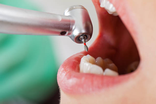 Best Emergency Root Canal Treatment in Swansea, IL